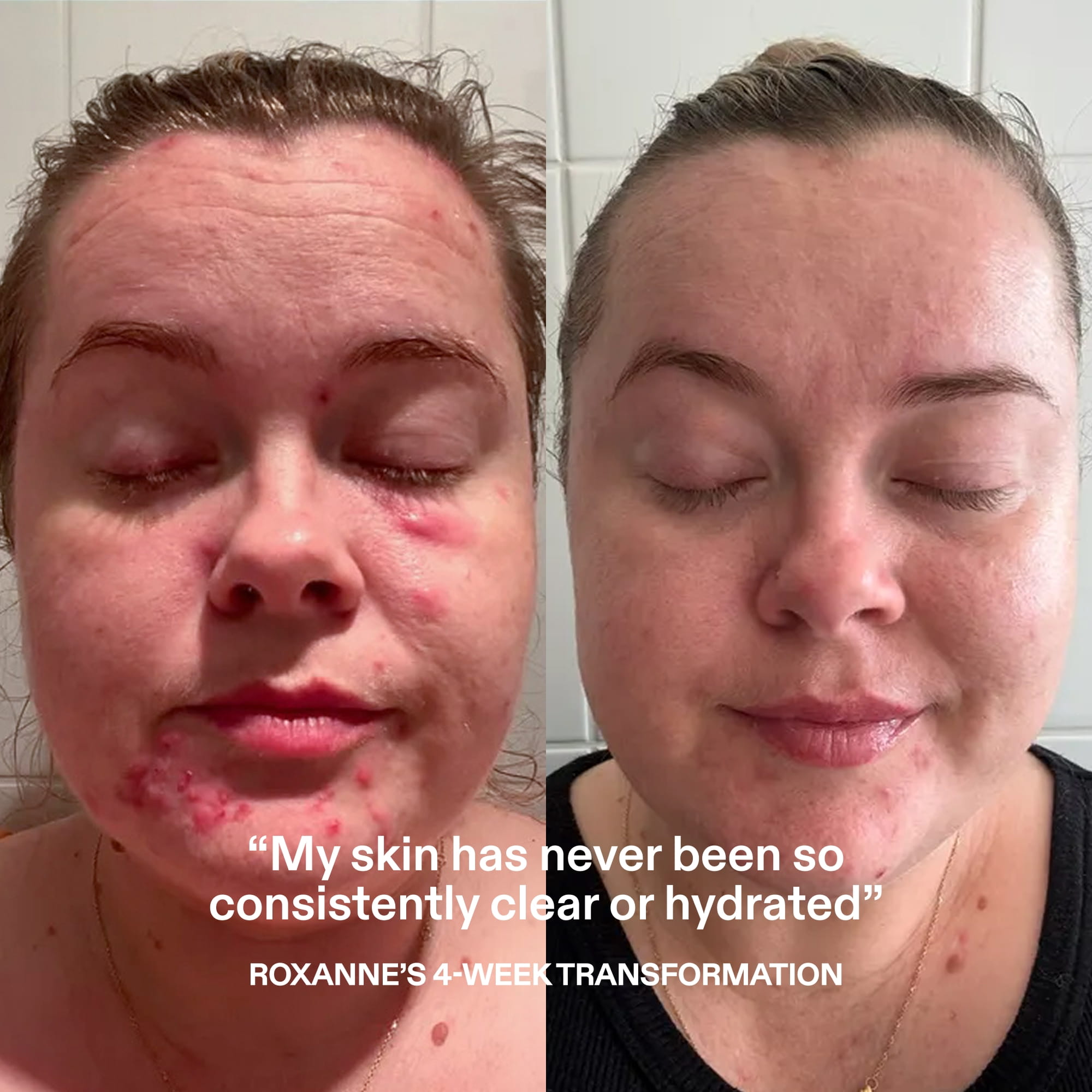 ST.SAJ Supreme Skin Kit customer transformation - Roxanne's 4-week skin results, consistently clear and hydrated skin